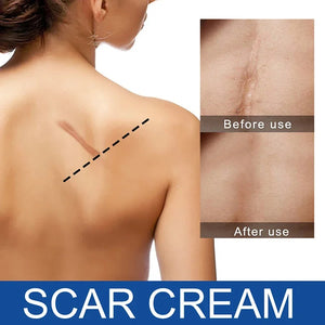 Silicone Scar Cream for Old and New Scars