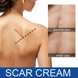 Silicone Scar Cream for Old and New Scars