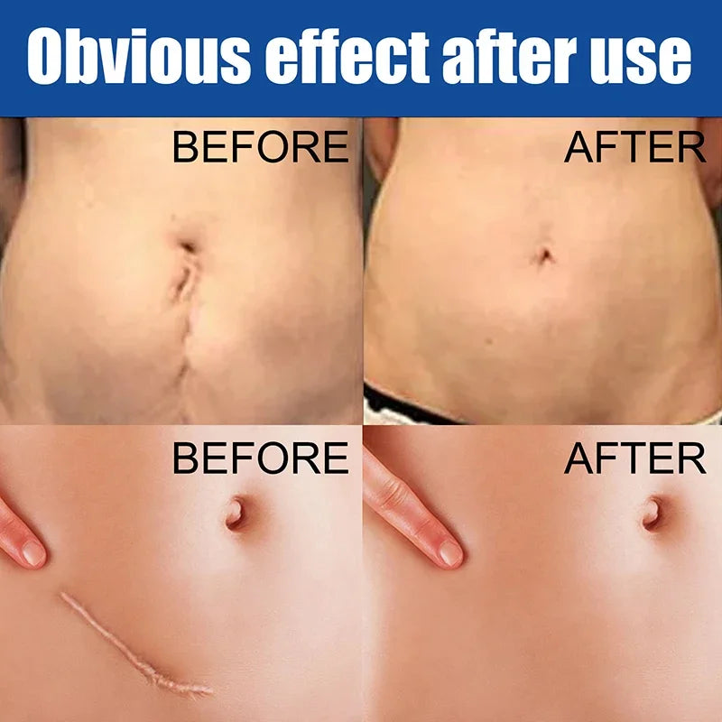 Silicone Scar Cream for Old and New Scars