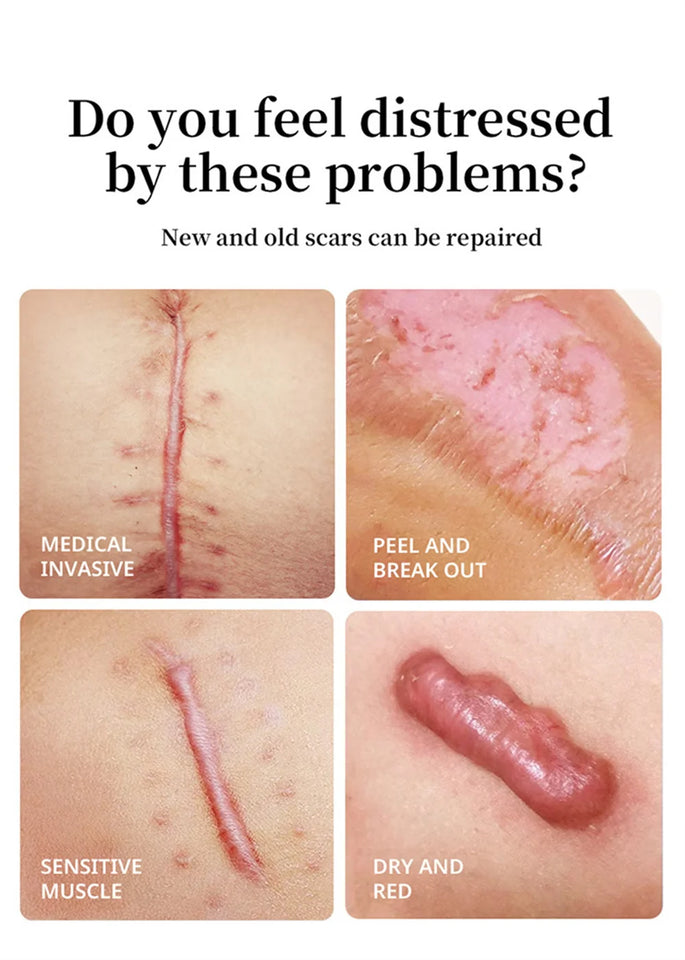 Silicone Scar Cream for Old and New Scars