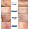 Silicone Scar Cream for Old and New Scars