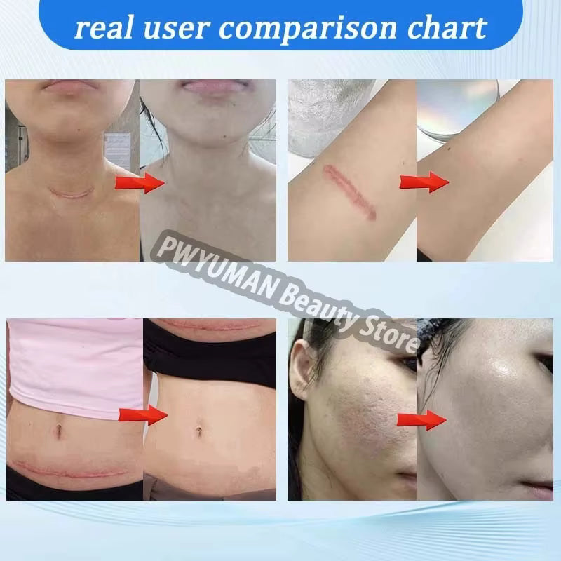 Silicone Scar Cream for Old and New Scars